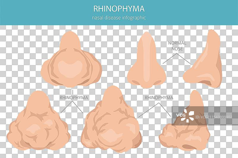 鼻赘鼻病医学信息图表图片素材