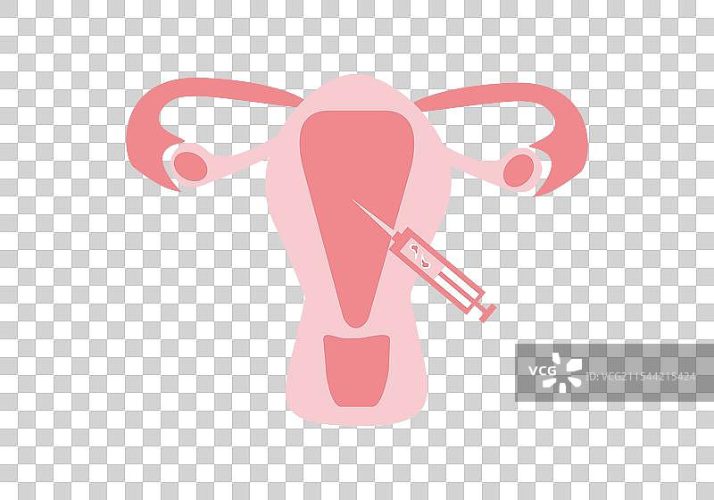 胚胎移植到子宫腔的IVF阶段图片素材