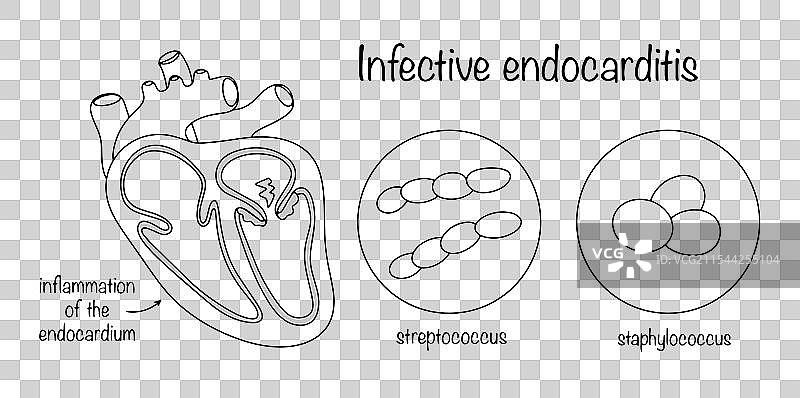 感染性心内膜炎图片素材