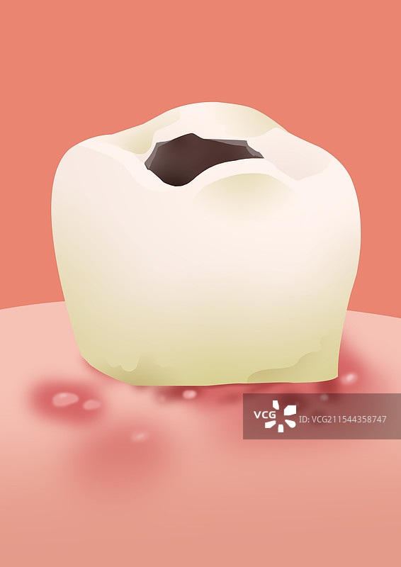 人体身体健康口腔疾病炎症病痛痛苦发炎口腔溃疡牙龈皮肤溃烂智齿拔牙科普插画图片素材