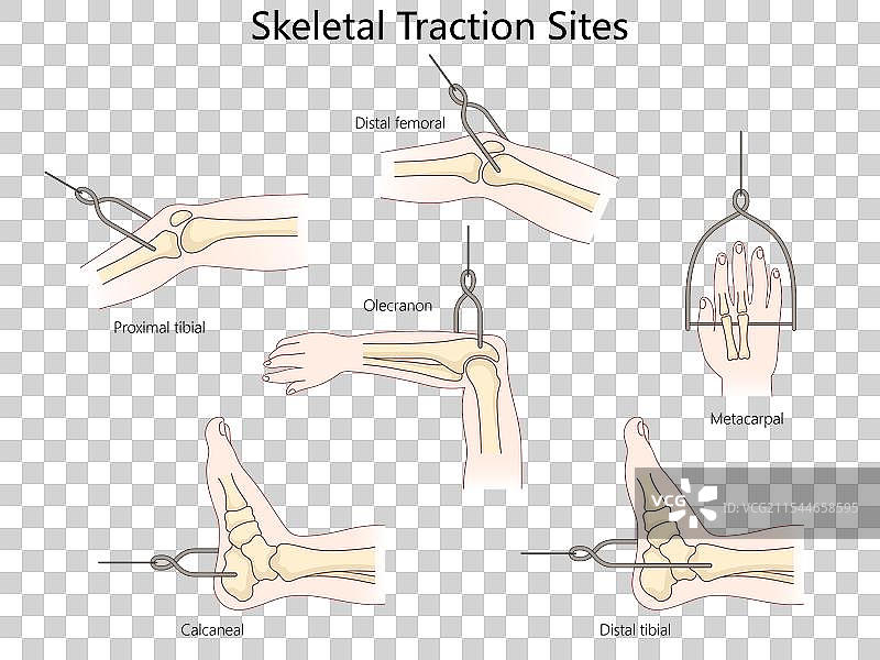骨骼牵引部位示意图 医学科学图片素材