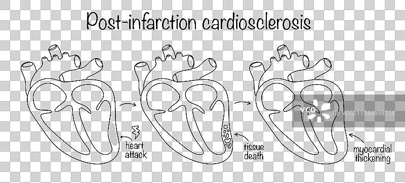 心肌梗死后心脏硬化图片素材