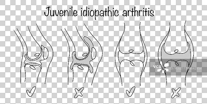 青少年特发性关节炎图片素材