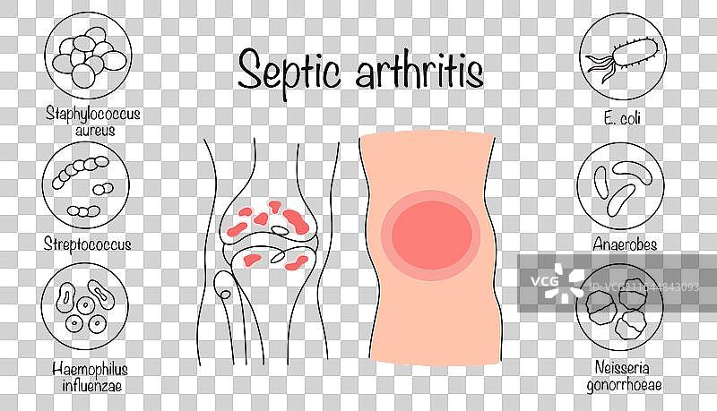 化脓性关节炎图片素材