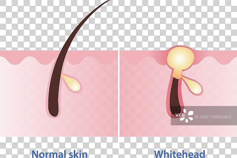 正常肤质和白头粉刺图片素材