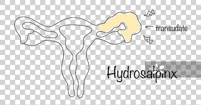 输卵管积水图片素材
