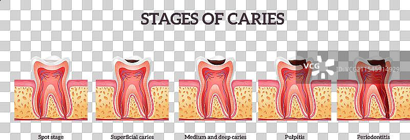 龋齿和牙齿破坏的不同阶段从斑点开始图片素材