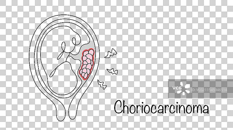 绒毛膜癌图片素材