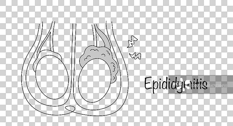 附睾炎图片素材