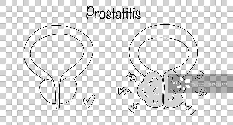 前列腺炎图片素材