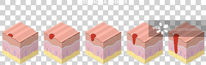 黑色素瘤的三维等距平面图图片素材