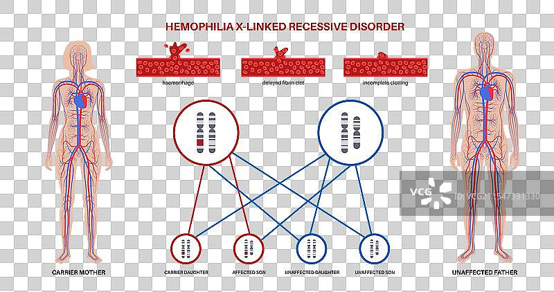 血友病遗传海报图片素材