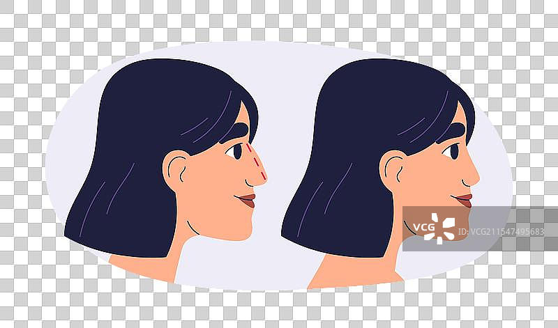 鼻整形手术前后的对比图片素材