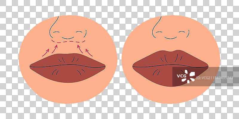 唇部增厚手术整形手术图片素材