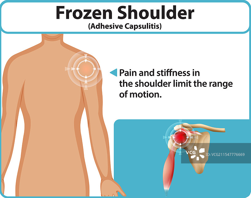 粘连性关节囊炎和肩部疼痛图片素材