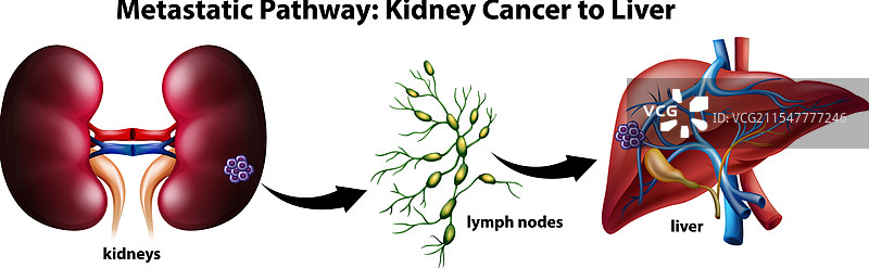癌症从肾脏扩散到肝脏图片素材