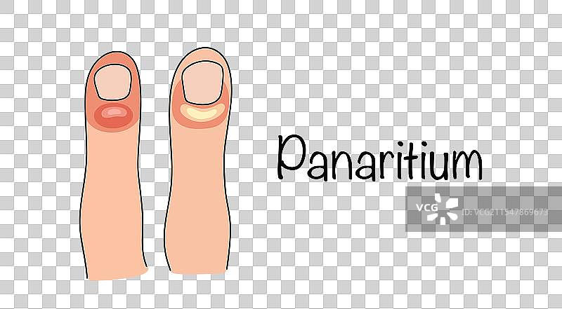 手指炎症图片素材