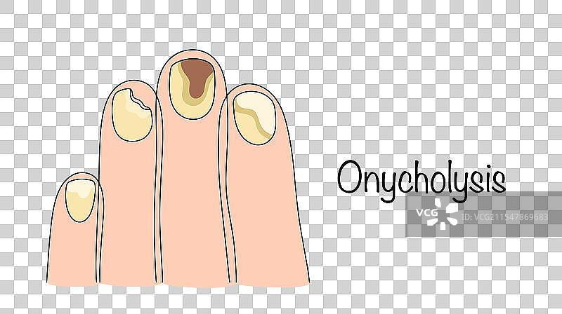 甲剥离症图片素材