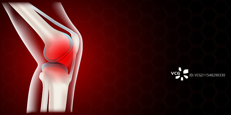 膝关节炎症和关节疼痛横幅图片素材