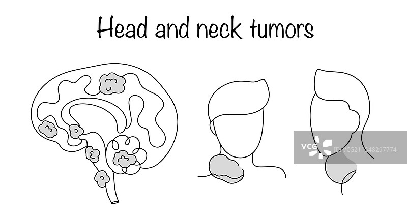 头颈肿瘤图片素材