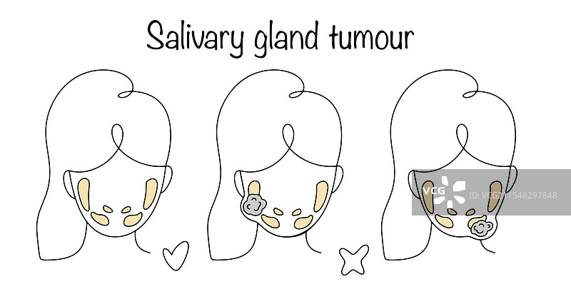 唾液腺肿瘤图片素材