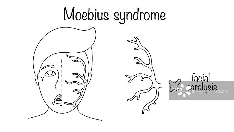 莫比乌斯综合症图片素材