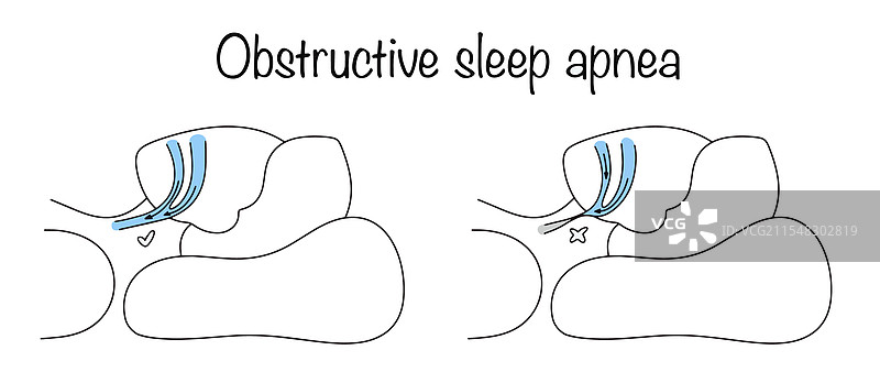 阻塞性睡眠呼吸暂停图片素材