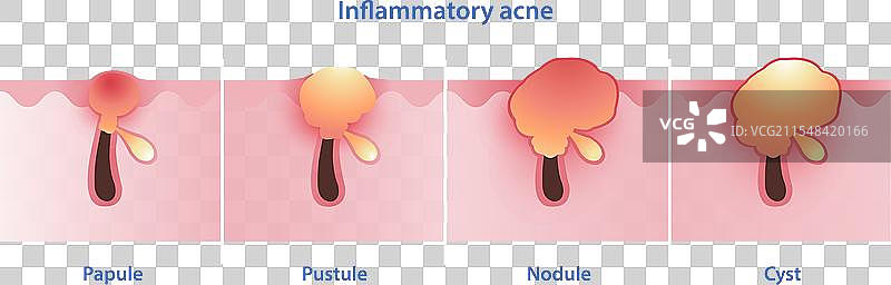炎性痤疮类型图解图片素材