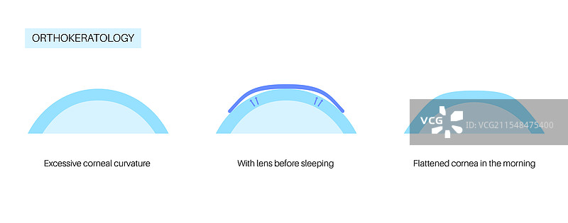 正视角接触镜图片素材