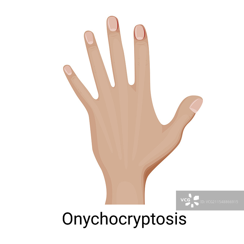 手部甲沟炎图片素材