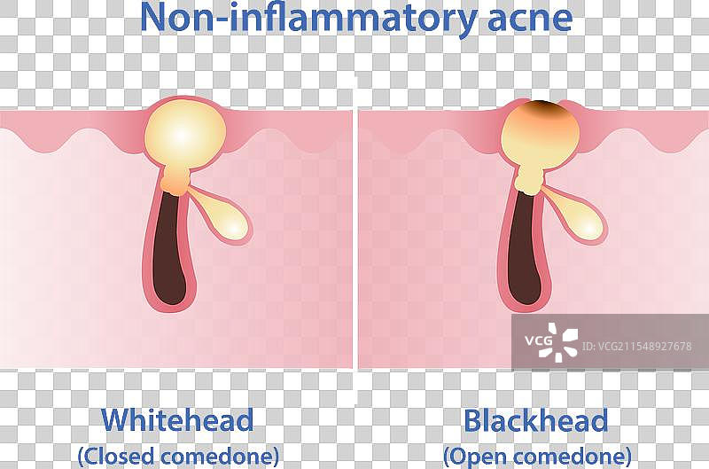 白头和黑头的区别图片素材
