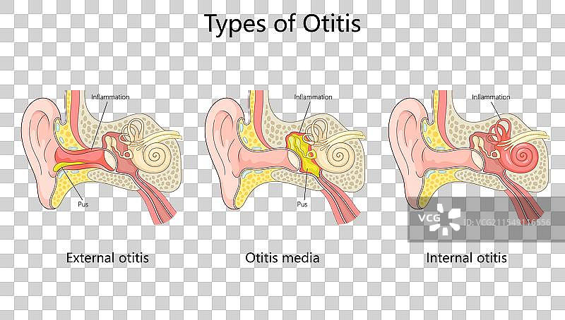 外耳道炎的类型及内耳感染图片素材
