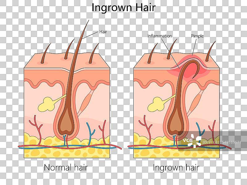正常与内生毛发结构图 医学图片素材