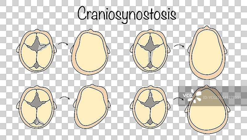 颅缝早闭症图片素材