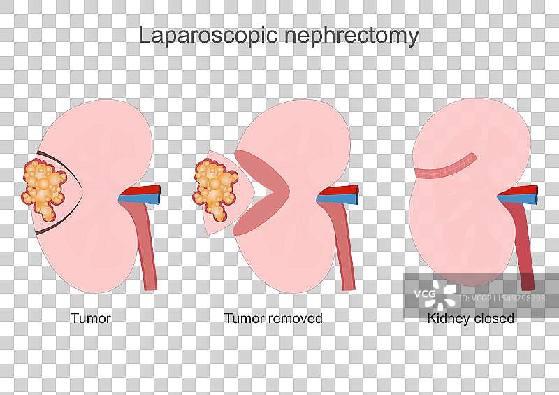 肾切除术是一项重大手术。图片素材