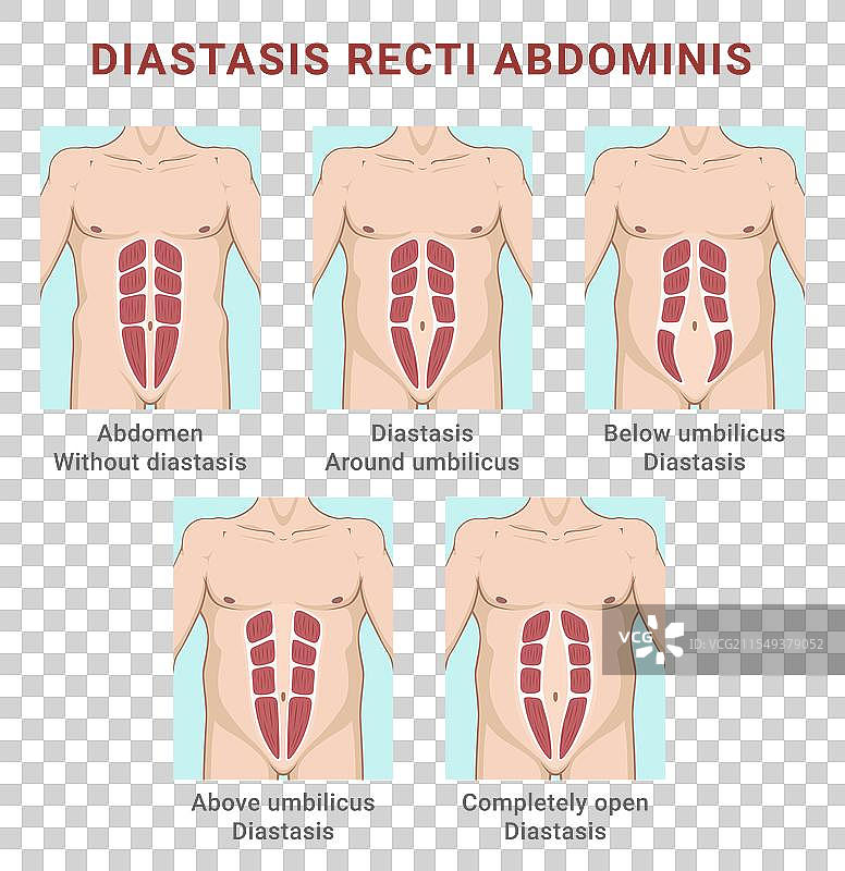 腹直肌分离类型图片素材