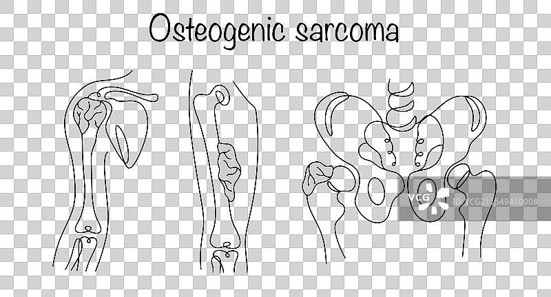 骨肉瘤图片素材