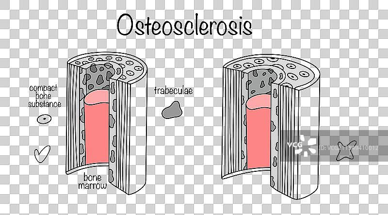 骨硬化症图片素材