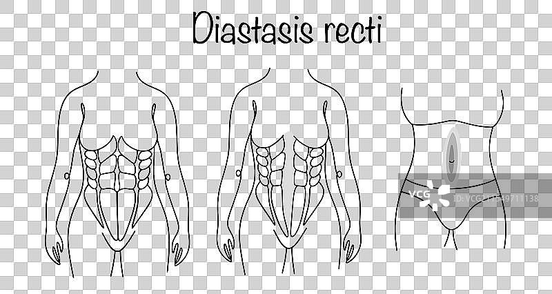 腹直肌分离图片素材