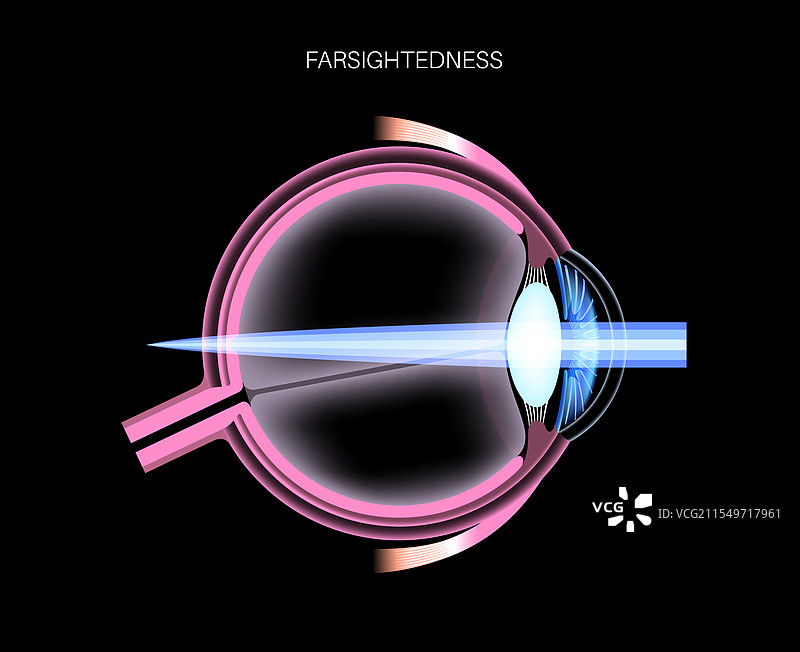 远视眼疾病图片素材