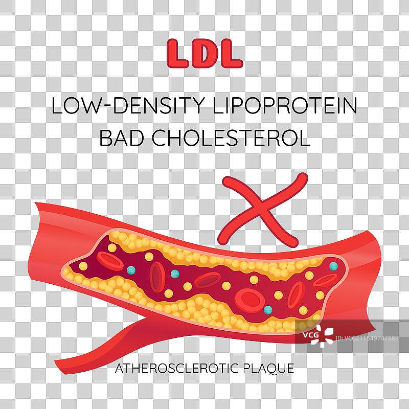 人类血管中的胆固醇类型图片素材