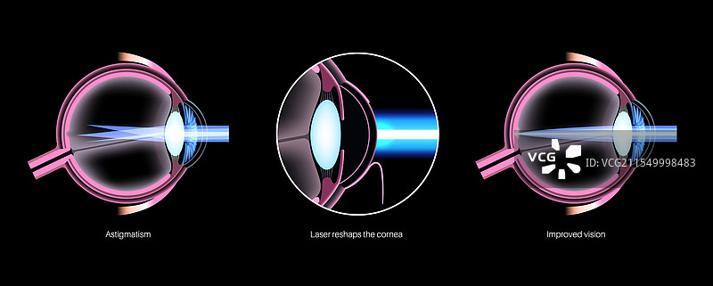 散光眼治疗图片素材