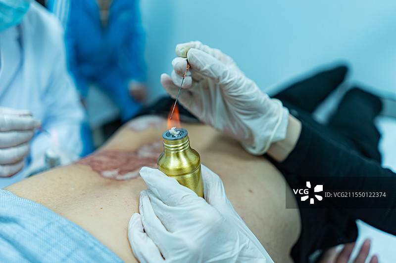 中国中医药服务拍摄主题，中医医院医生正在给病人患者后背火疗针灸拔罐，室内无人图像摄影图片素材