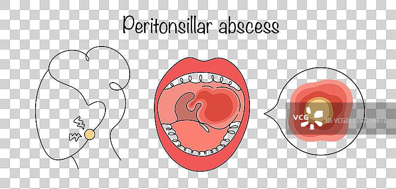 扁桃体周围脓肿图片素材