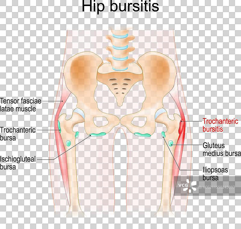 髋关节滑囊炎、肌肉、滑液囊和骨骼图片素材