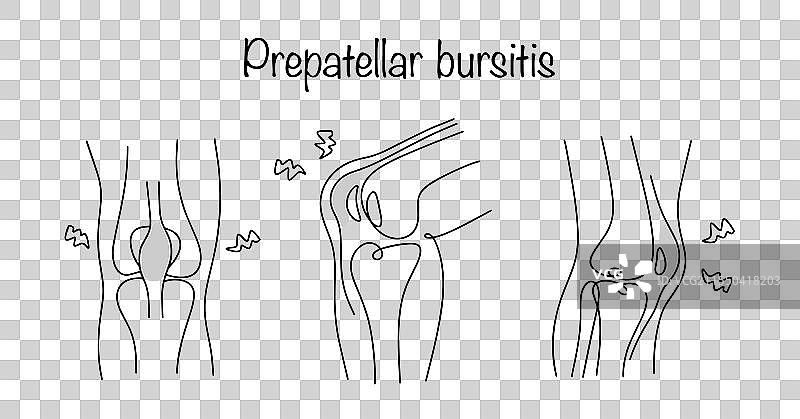 髌前滑囊炎图片素材