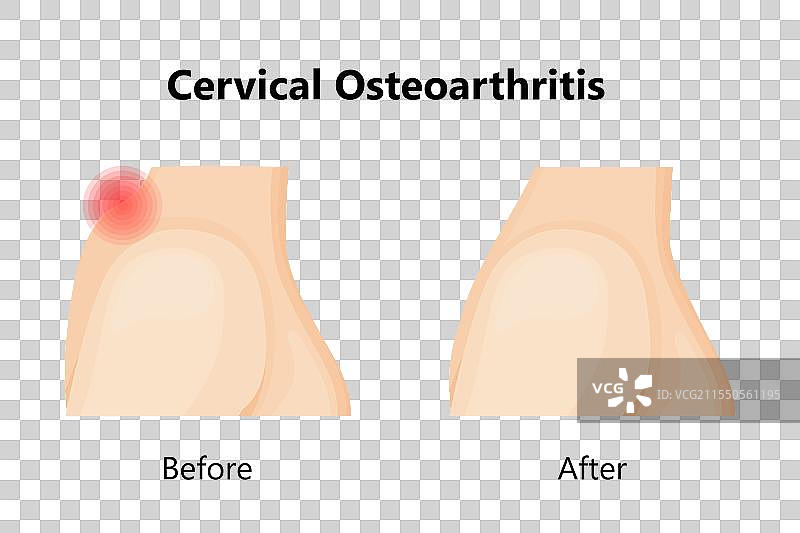 颈椎骨关节病的医疗护理前后图片素材