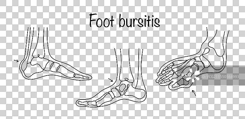 足部滑囊炎图片素材