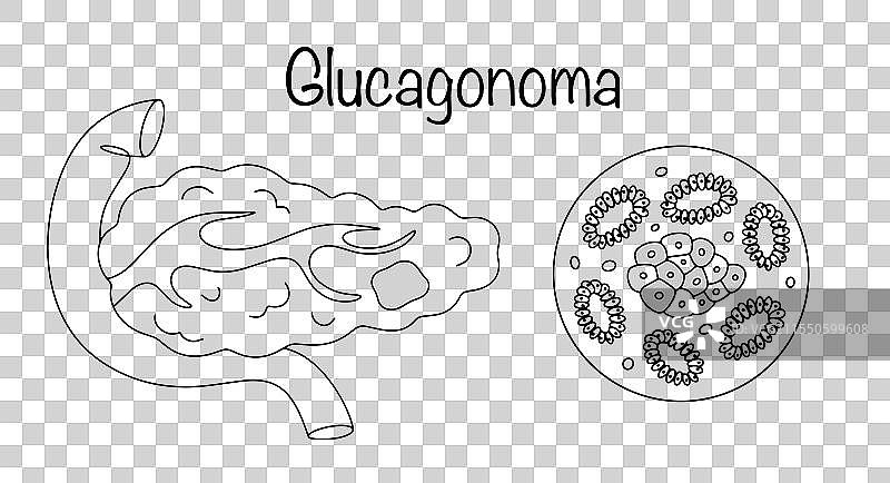 胰高血糖素瘤图片素材