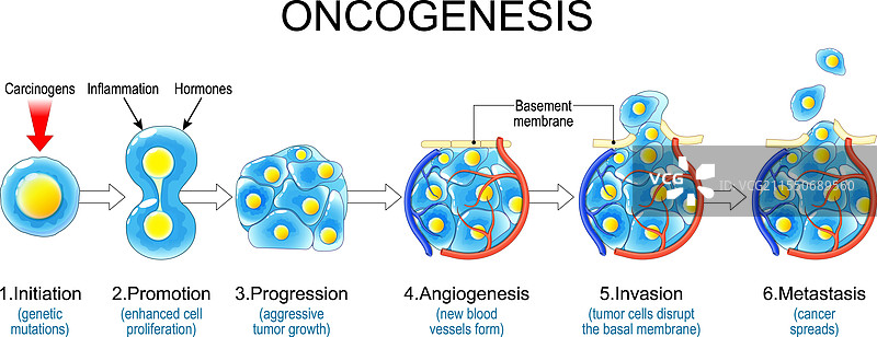 癌变、肿瘤发生、癌症的阶段图片素材